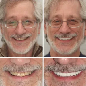 ROSOPL™ Custom-Fit Functional Denture