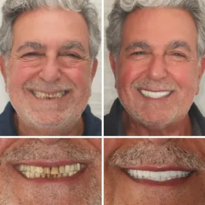 ROSOPL™ Custom-Fit Functional Denture
