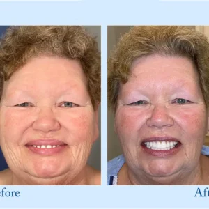 TrueEase™ Custom-Fit Functional Dentures – Full Set