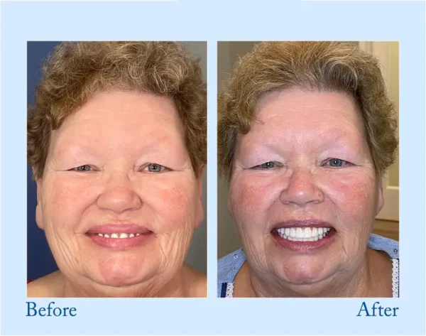 TrueEase™ Custom-Fit Functional Dentures – Full Set