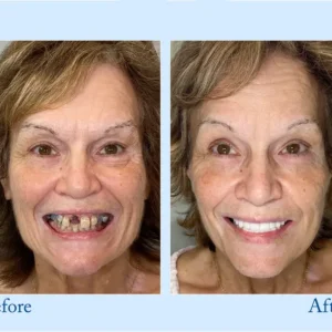 TrueEase™ Custom-Fit Functional Dentures – Full Set