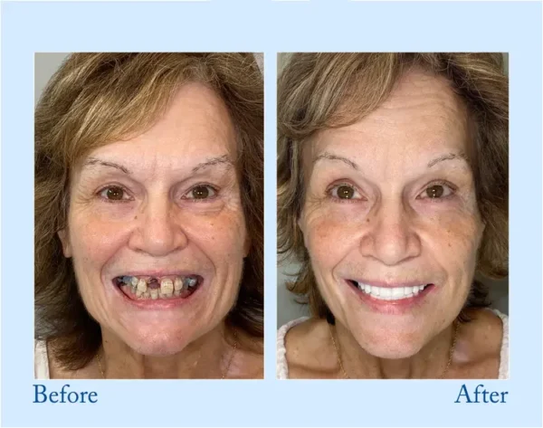 TrueEase™ Custom-Fit Functional Dentures – Full Set