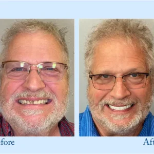 TrueEase™ Custom-Fit Functional Dentures – Full Set