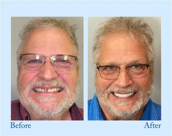 TrueEase™ Custom-Fit Functional Dentures – Full Set