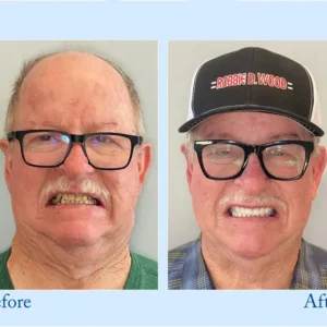 TrueEase™ Custom-Fit Functional Dentures – Full Set