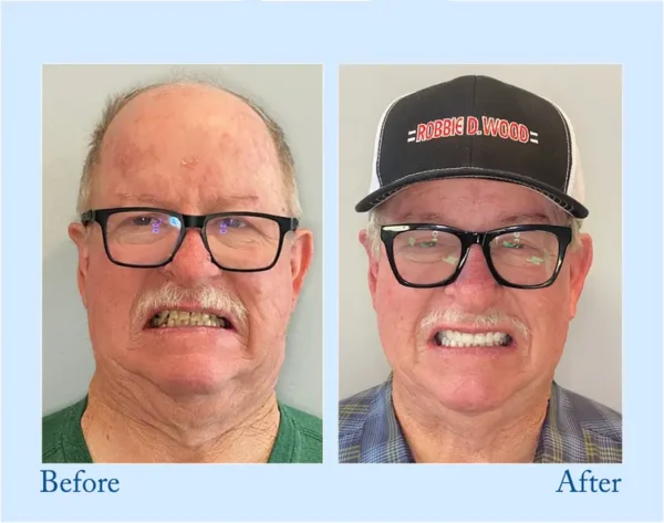 TrueEase™ Custom-Fit Functional Dentures – Full Set