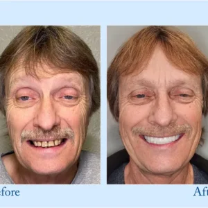 TrueEase™ Custom-Fit Functional Dentures – Full Set