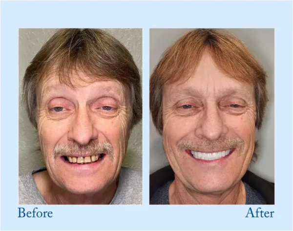 TrueEase™ Custom-Fit Functional Dentures – Full Set