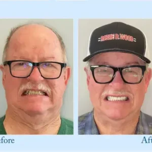 TrueEase™ Dentures