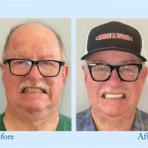 NESLEMY™ Custom-Fit Functional Dentures - Perfectly Fitted in Minutes at Home