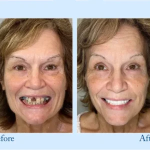 NESLEMY™ Custom-Fit Functional Dentures - Perfectly Fitted in Minutes at Home