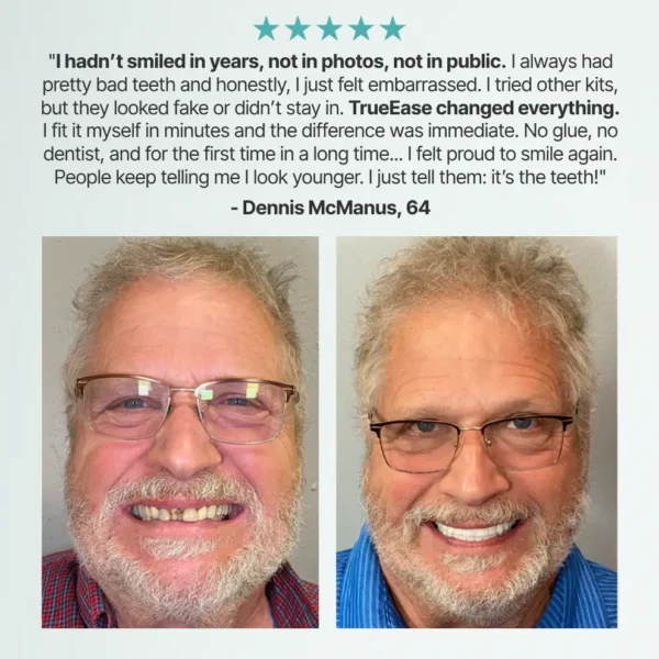 TrueEase™ Custom-Fit Full Functional Dentures